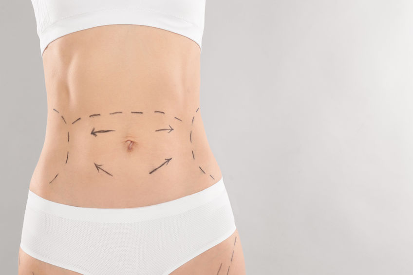 Chirurgie esthétique du ventre : Tablier Graisseux – Abdominoplastie du Docteur Professeur Nizet du CMML à Liège