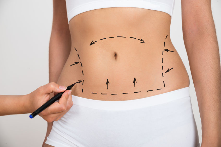 Chirurgie esthétique du ventre Surcharge graisseuse - Lipoaspiration du Docteur Professeur Nizet du CMML à Liège